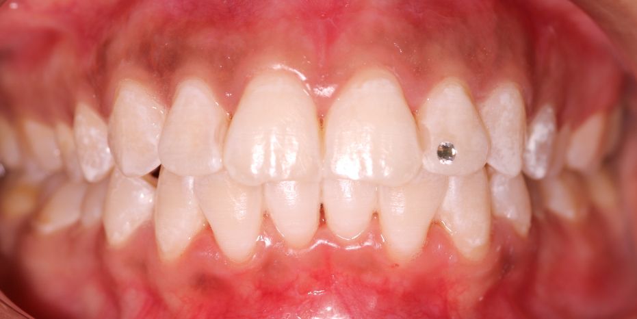BLANQUEAMIENTO DENTAL  